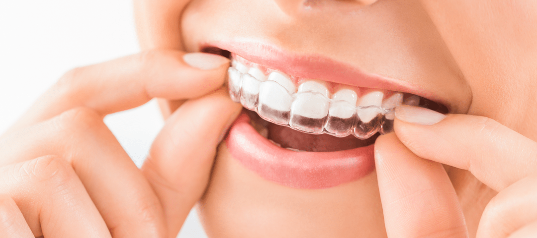 ortodonciainvisalign