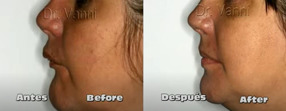 cambio radical de perfil y labios