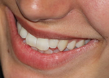 estética dental en marbella