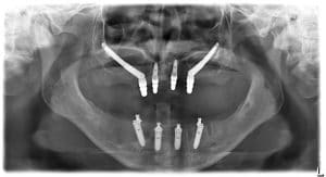 implantes zigomaticos en marbella